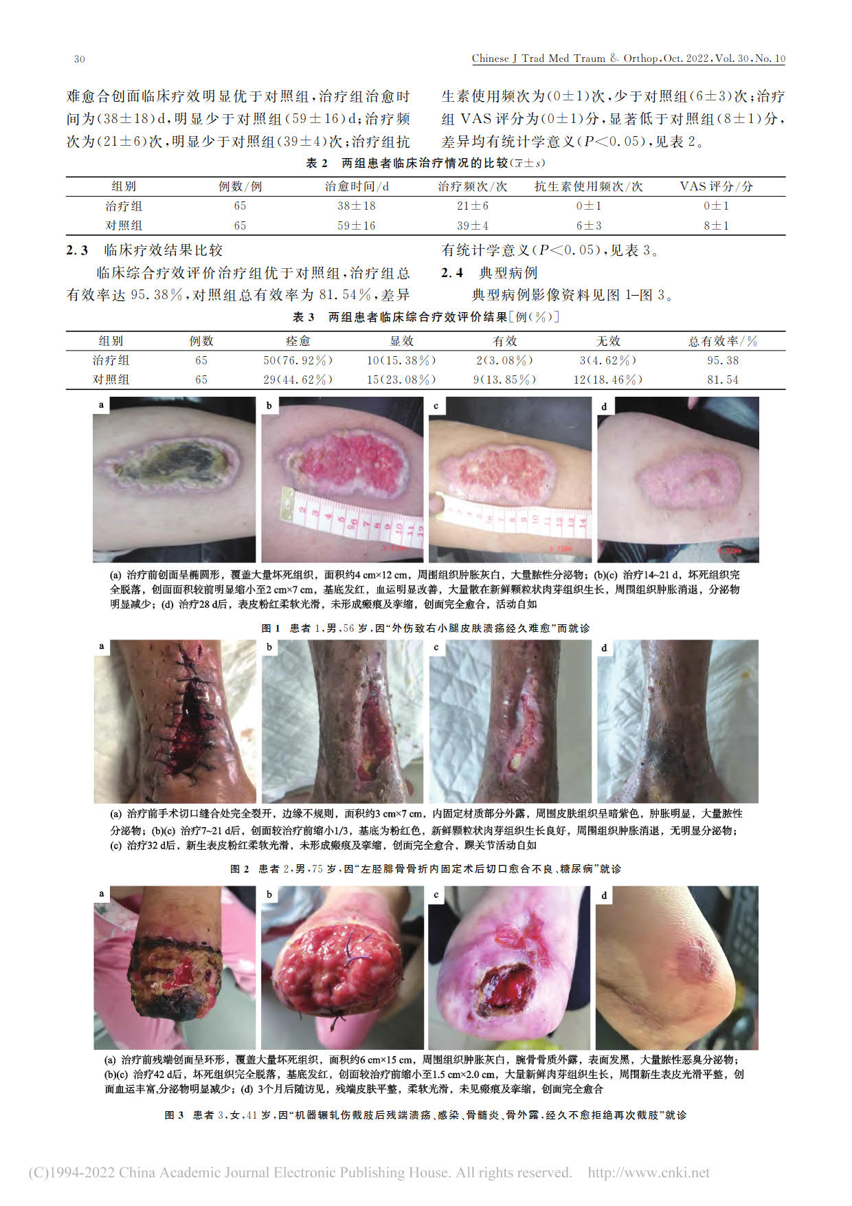 仁宝生肌膏联合红_蓝光治疗慢性难愈合创面的疗效(图2)